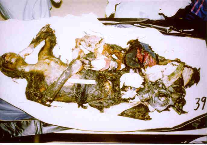 Carmel Doe 39 Autopsy photograph of the alleged remains of Novellette Hipsm...